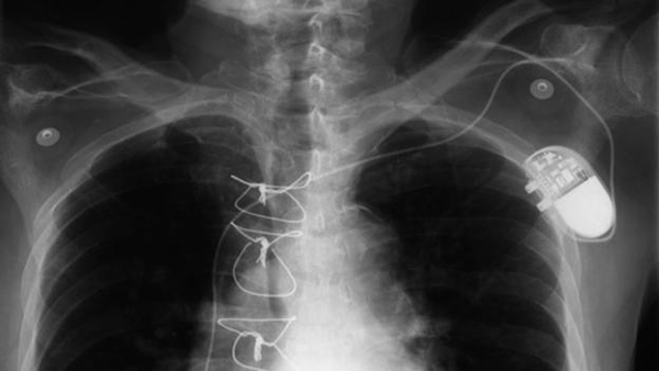 X-ray of an implanted cardiac defibrillator.